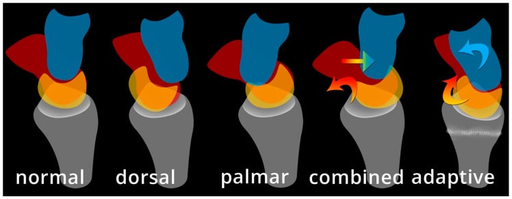 Five schematic lateral carpal alignments comparing normal, dorsal, palmar, combined and adaptive midcarpal instability.