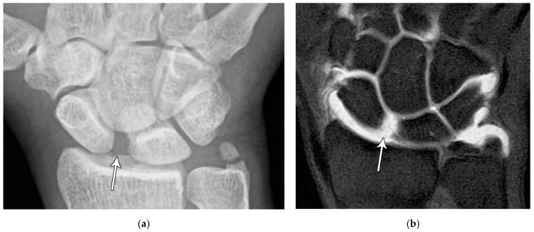 PA wrist radiograph showing scapholunate widening beside a coronal MR arthrogram showing scapholunate ligament disruption.