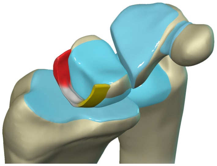 Three-dimensional illustration of the dorsal, proximal membranous and volar components of the scapholunate ligament.