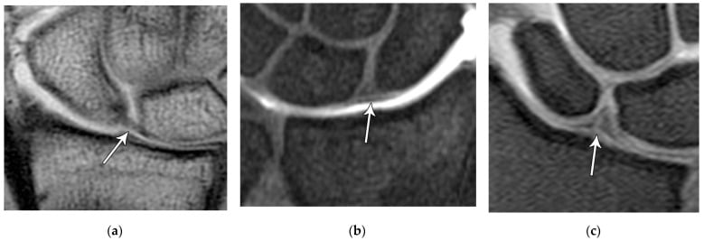 Coronal wrist MRI examples showing normal scapholunate ligament morphology and a proximal scapholunate tear.