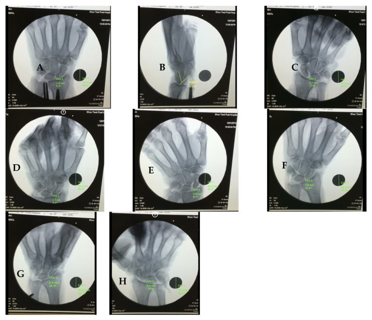 Eight representative wrist radiographs demonstrating scapholunate widening across neutral and stress projections.