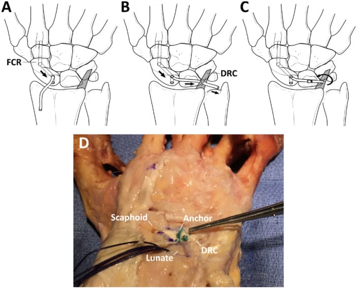 Diagrams and operative photograph of three-ligament tenodesis using an FCR tendon strip through the scaphoid and dorsal radiocarpal ligament.