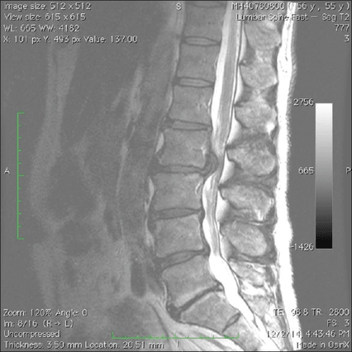 Sagittal lumbar MRI showing a postoperative epidural collection causing cauda equina syndrome
