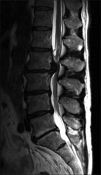 Sagittal T2 lumbar MRI of the cauda equina from a reported post-spinal-anaesthesia arachnoiditis case