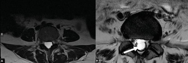 Axial lumbar MRI comparison showing cauda equina roots adherent to the thecal sac in the empty-thecal-sac pattern of adhesive arachnoiditis
