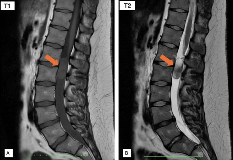 Sagittal T1 and T2 lumbar MRI showing an intradural cauda equina neuroendocrine tumour