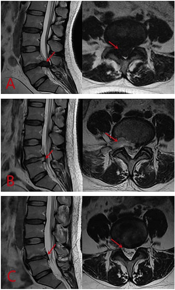 Serial sagittal and axial T2 lumbar MRI before and after endoscopic removal of a central L5-S1 disc herniation causing cauda equina syndrome