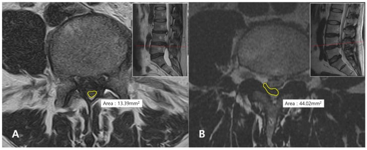 Axial and sagittal lumbar MRI comparison showing measurement of dural-sac cross-sectional area in disc herniation with and without cauda equina syndrome