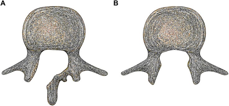 Axial schematic comparing unilateral hemilaminectomy with complete laminectomy