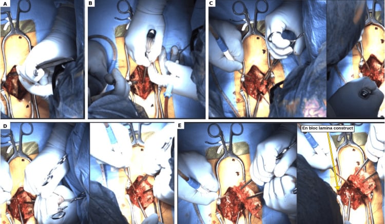 Operative sequence showing bilateral troughing and controlled en-bloc lumbar lamina removal