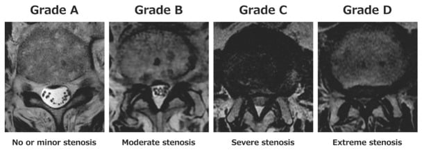 Axial T2 lumbar MRI examples of Schizas grades A to D spinal canal stenosis