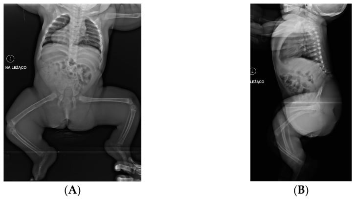 AP and lateral infant radiographs showing complete sacral agenesis