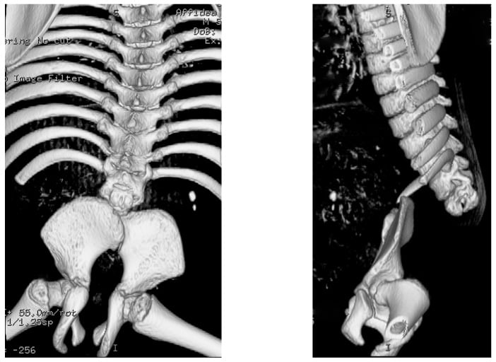 Three-dimensional CT showing total sacral and lower-lumbar agenesis