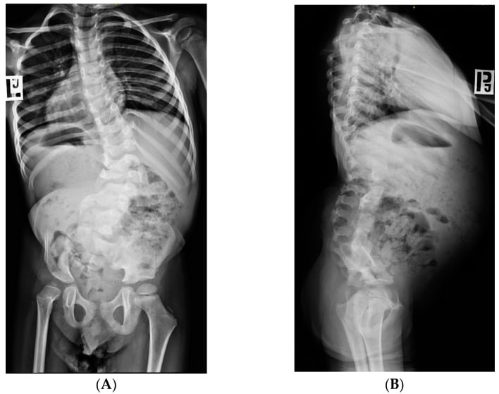 AP and lateral radiographs showing partial sacral agenesis with scoliosis and hip dysplasia