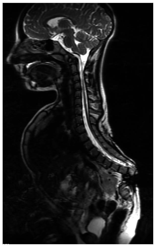 Whole-spine MRI showing atypical caudal regression with absent lower lumbar vertebrae and sacral hypoplasia