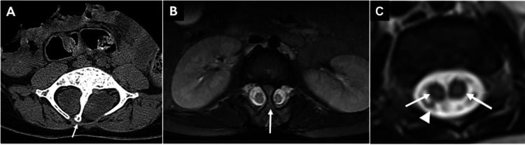 Axial CT and MRI showing diastematomyelia with two hemicords