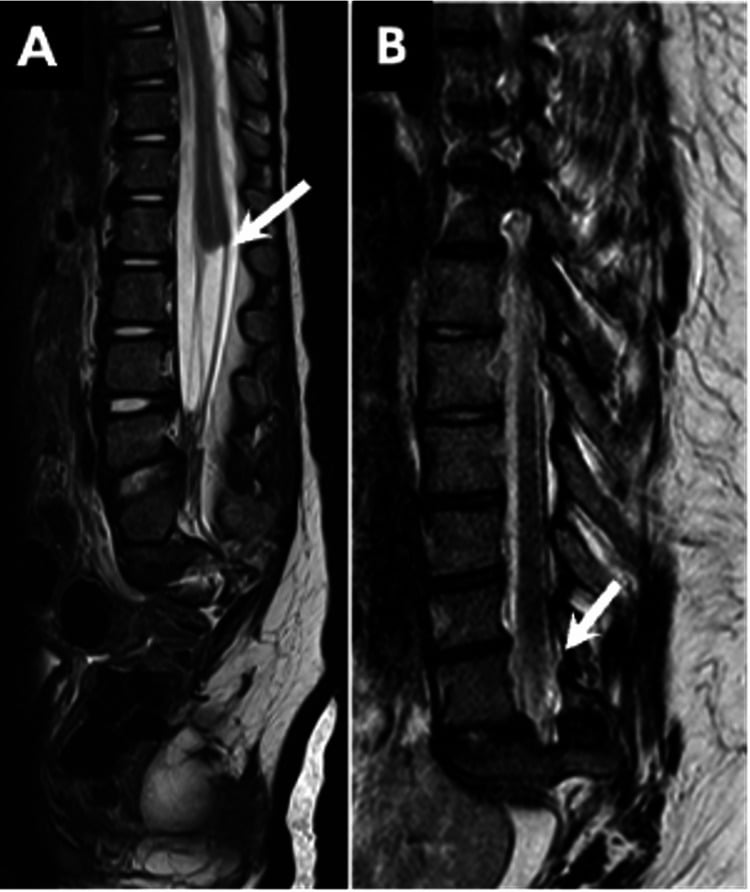 Sagittal MRI comparing a high truncated conus with a low tethered conus in caudal regression