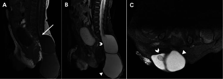 Sagittal and axial MRI showing a low tethered conus with terminal cystocele