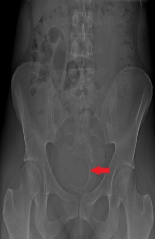 AP pelvic radiograph showing the scimitar sign of anterior sacral meningocele