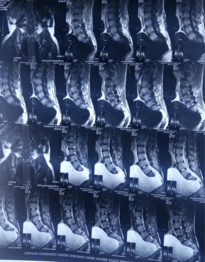 Sagittal MRI showing a large anterior sacral meningocele filling the pelvis