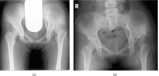 Two-panel AP pelvis radiographs showing hip dysplasia associated with partial sacral agenesis