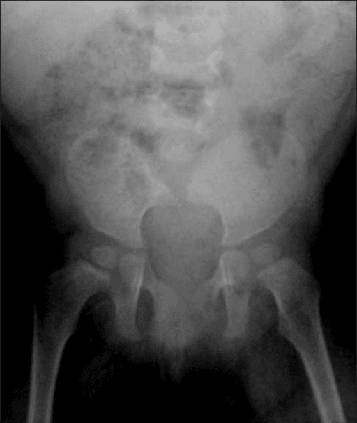AP pelvis radiograph of a young child showing complete sacral agenesis with iliac wings approximating centrally