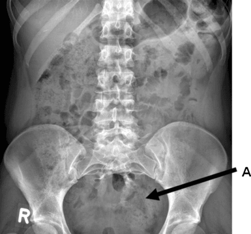 AP abdominopelvic radiograph showing partial lower sacral agenesis