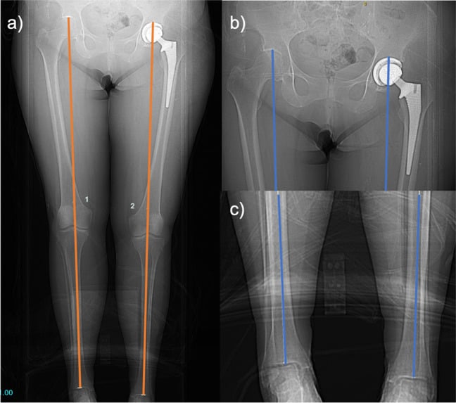 CT scanogram with the acetabular-apex to tibial plafond distance drawn.