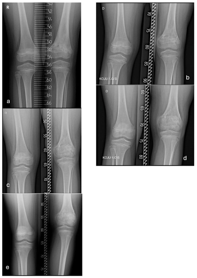 Serial standing radiographs documenting a progressive post-traumatic limb-length discrepancy.