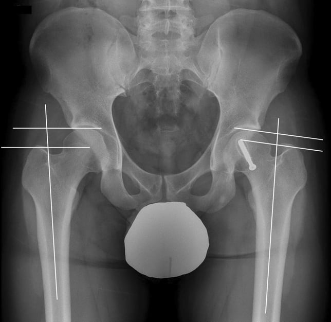 Supine AP pelvic radiograph with the articulotrochanteric distance measured on each side.