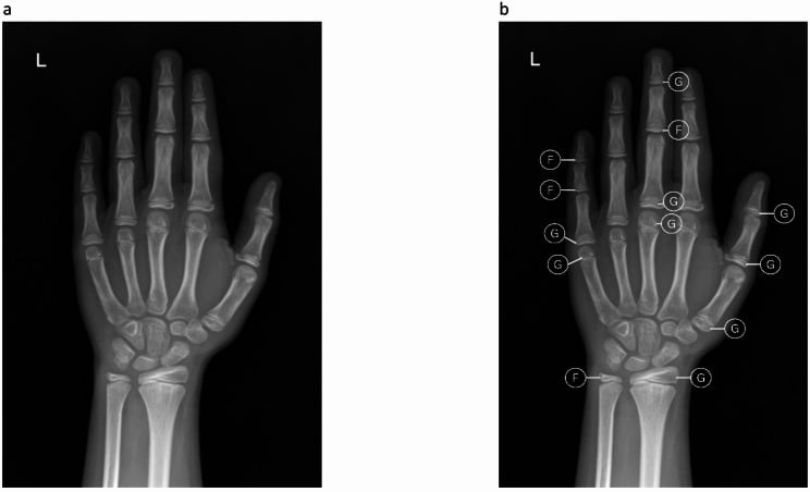 Paediatric hand-wrist radiograph used for skeletal age assessment.
