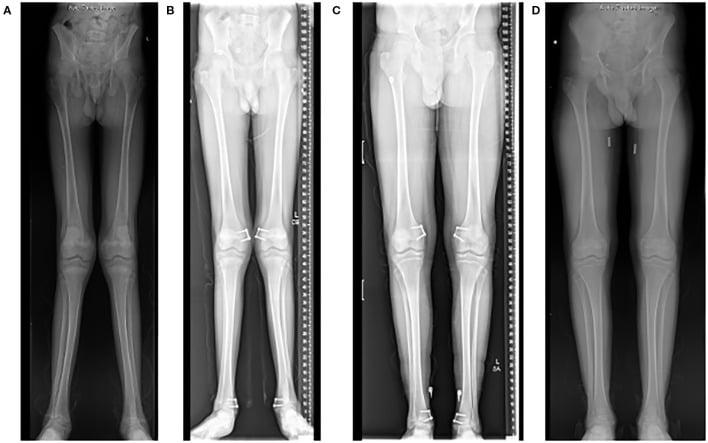 Serial calibrated long-leg radiographs documenting discrepancy across growth and after correction.