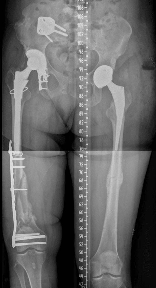Full-length standing radiograph of both femurs with the left femur longer than the right