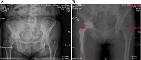 Anteroposterior pelvic radiograph showing right hip osteoarthritis with limb-length inequality