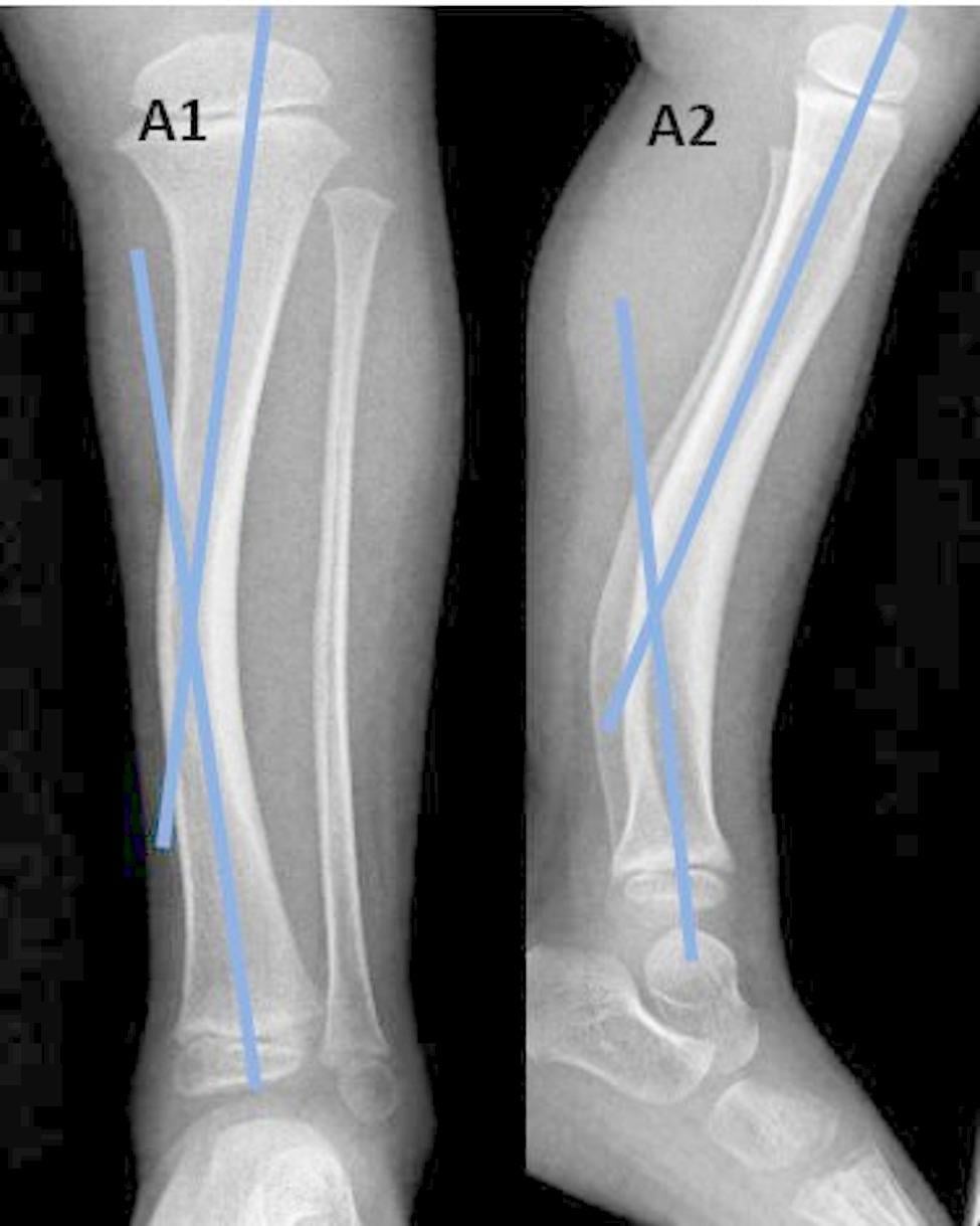Infant tibial radiographs with the medial and posterior diaphyseal bows measured.