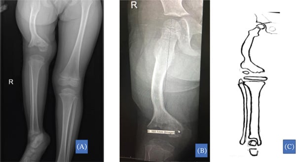 Long-leg radiograph and diagram of congenital short femur with lateral condyle hypoplasia.