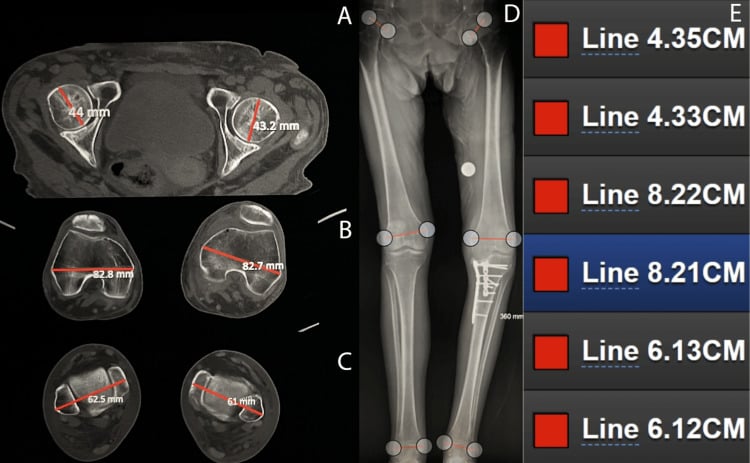 CT scanogram with femoral head, knee and ankle joint-level measurements.