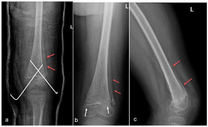Paediatric distal femoral radiographs after physeal fracture fixation.