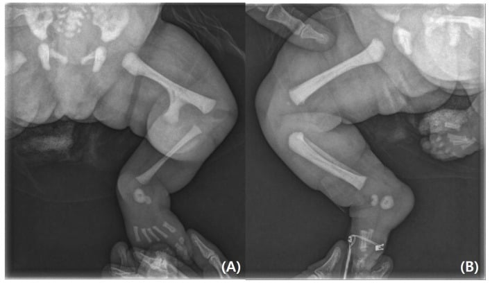 Lower-limb radiographs comparing femoral bifurcation with tibial and patellar agenesis against the normal side.