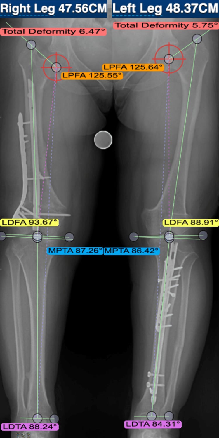 Full-length standing radiograph with femoral and tibial segment lengths measured against the calibration ruler.