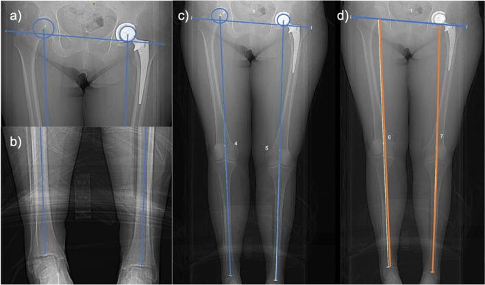 CT scanogram with the inter-teardrop to tibial plafond distance drawn.