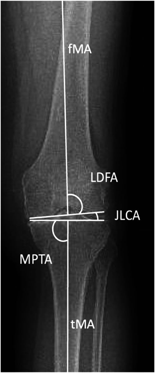 Standing long-leg radiograph with the mechanical-axis angular measurements (LDFA, MPTA, JLCA) drawn.