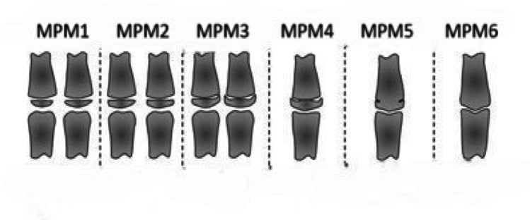 Diagram of the six Fishman middle-phalanx maturation stages used in skeletal age assessment.