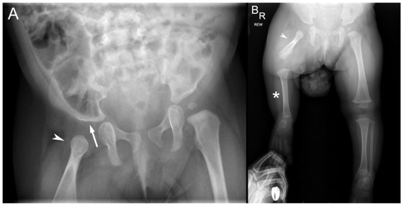 Infant pelvic radiograph with dysplastic acetabulum and malformed proximal femur.