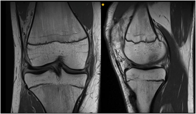 Coronal MRI of the proximal tibia showing a physeal bar.