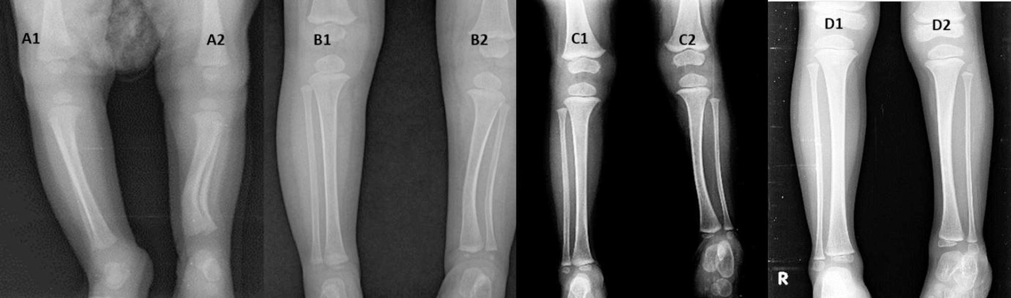 Serial radiographs of a bowing tibia showing remodelling with persistent proportional shortening.