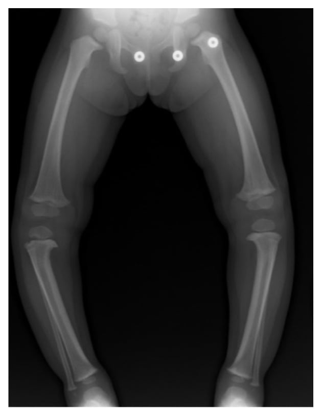 Diagram of correct patellae-forward positioning for the standing AP radiograph.