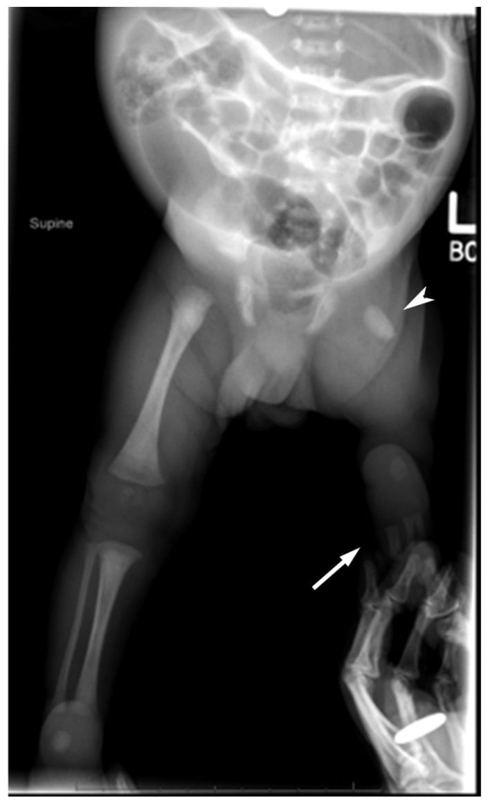 Infant lower-limb radiograph with a diminutive femur, absent tibia and fibula and three digital rays.