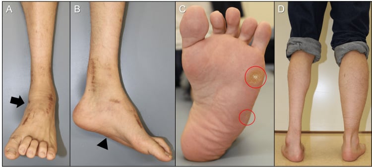 Photographs at twenty-four months showing improved foot and ankle supination, a lowered medial longitudinal arch, reduced plantar callosities and both legs in stance