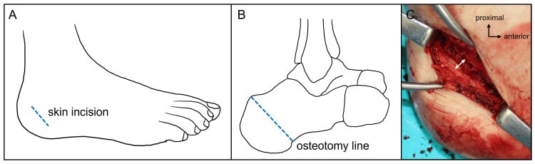 Diagram of the lateral calcaneal skin incision and osteotomy line with an intraoperative photograph of the posterior fragment displaced laterally